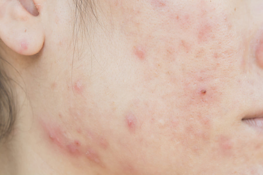 acne-scar-face-skin-problem (1).jpeg